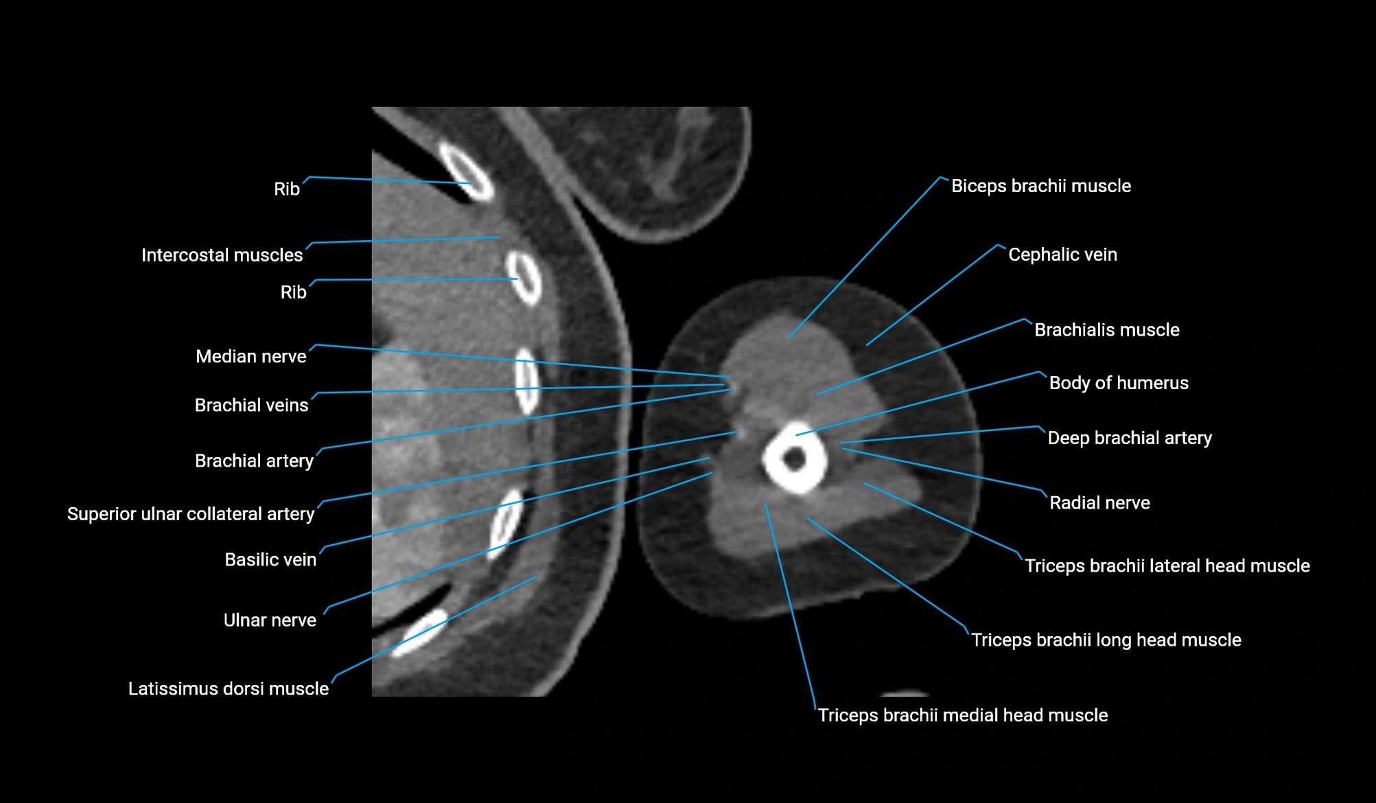 CT upper arm axial  cross sectional anatomy labelled radiology image -00286.webp